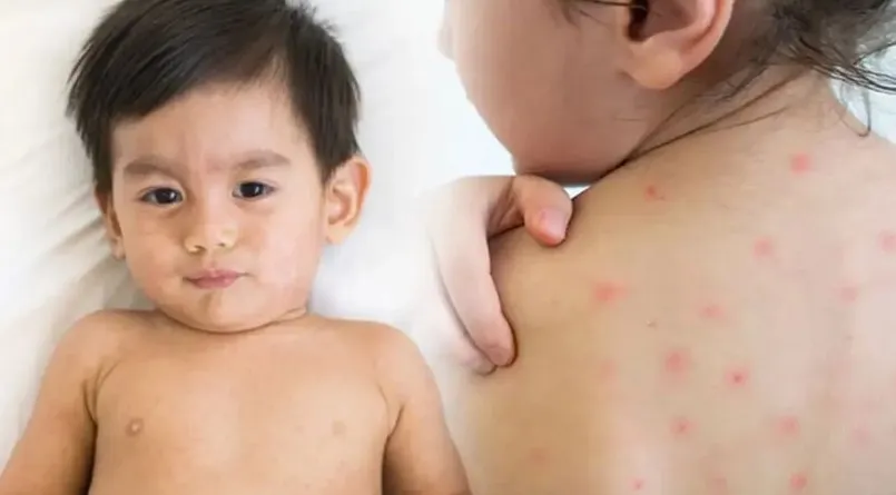 বরিশালে হাম উপসর্গ নিয়ে আরও ২ শিশুর মৃত্যু 